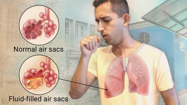 A health diagram showing the air sacs of an infected lung. (Photo via Google)
